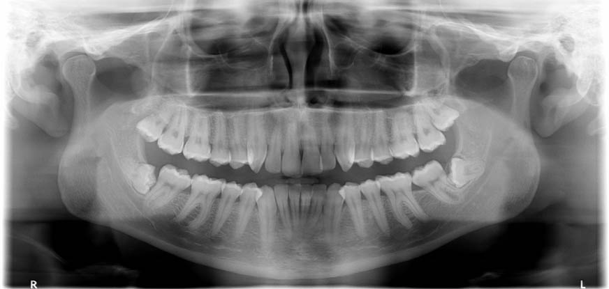 Wisdom Tooth Removal in London